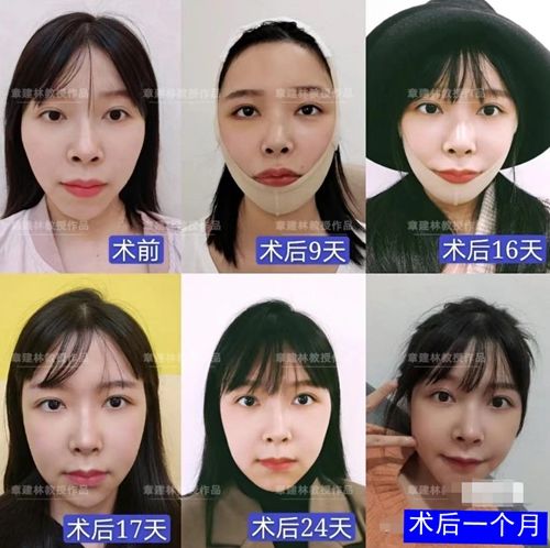 我出生时下巴后缩非常严重。 从正面看还不错，但从侧面看好像没有下巴垫。