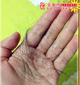 头顶掉头发梦见剪短了_做梦掉头发谢顶_梦见自己头顶掉头发