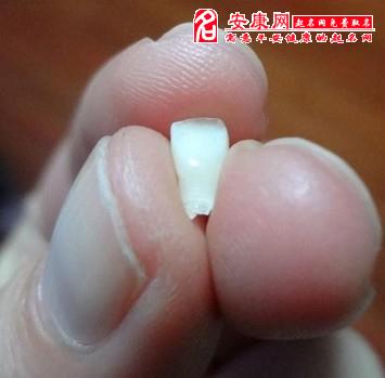 脱落牙齿右上面梦见掉了_脱落牙齿右上面梦见掉了一颗_梦见右上面牙齿脱落
